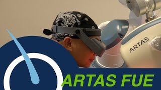 How Does an ARTAS Robotic Hair Transplant Work [upl. by Akinoj]