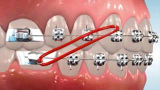 Class 2 Elastics  Easton Ortho 101 with Dr Loftus [upl. by Yenruoj]