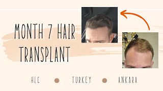 Loving It Month 7 Hair Transplant HLC clinic Turkey [upl. by Briny]