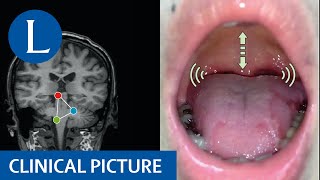 Chronic clicking tinnitus due to palatal tremor essential or secondary [upl. by Gilda]