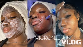 Microneedling Vlog First Time Experience  Before and After [upl. by Giuliana]