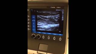 Ultrasound Guided Rectus Sheath Block [upl. by Nohsreg]