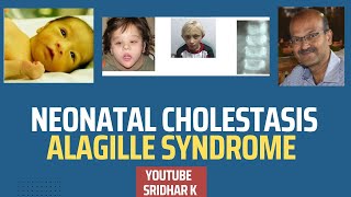 Alagille syndromewhat is Watson Alagille Syndrome neonatalcholestasis alagillesyndrome [upl. by Naujyt]