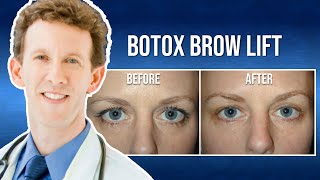 What is a Botox Brow Lift  Non Surgical Procedure [upl. by Altis538]