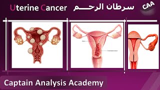 E4 Understanding Endometrial Cancer Uterine cancer سرطان الرحم اسبابة وطرق تشخيصة و علاجه [upl. by Agemo]