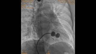 balloon mitral valvotomy in mitral stenosis patient [upl. by Imotas]