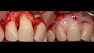 Periodontal Surgery with Emdogain [upl. by Francis]