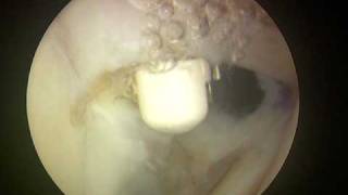 Shoulder Arthroscopy Dr Cascio Biceps tenodesis 2 of 2 [upl. by Ahsaten]