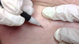 Removal of Fibroma on the Neck [upl. by Ayeka]