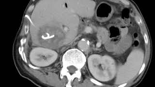 HBP C3 Liver Percutaneous drainage [upl. by Ahkos]