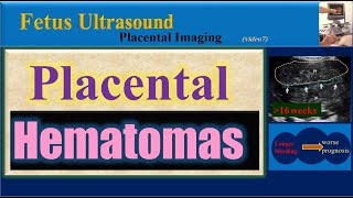 Fetus Ultrasound Placental Hematomas [upl. by Airetak]