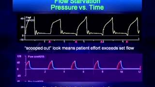 Mechanical Ventilation Waveform Analysis [upl. by Halyahs]