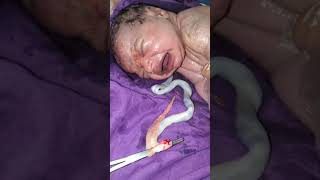 Vernix lot of 2 meters Newborn baby nurse and doctor cleaning it with soap and spinal cords cutt [upl. by Grimaud597]