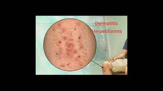 🍁 Dermatitis Herpetiformis 🍁 [upl. by Edmee]