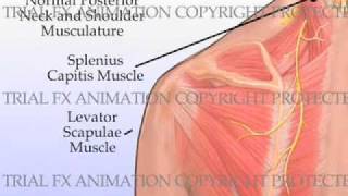 Trigger Point Injections [upl. by Genesa68]