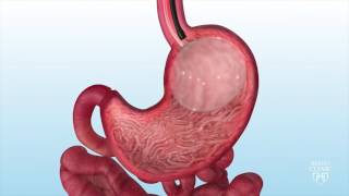 Intragastric Balloon for Weight Loss  Mayo Clinic [upl. by Gabbie]