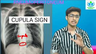 INTEGRATED SHOT3 PNEUMOPERITONEUM Radiology CUPULA Continous Diaphragm RIGLER ligament SIGNS [upl. by Vel]