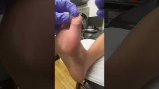 Witness this Aussie Podiatrist work wonders on big toe callus FootCare PodiatryMagic [upl. by Tedda]