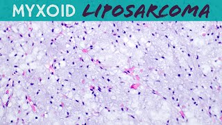 Myxoid Liposarcoma explained in 5 minutes basic soft tissue pathology sarcoma pathologists [upl. by Eilesor537]