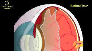 Eye Floaters Retinal Tears and Retinal Detachments [upl. by Kirchner845]