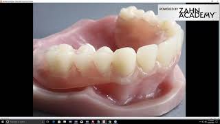 OnDemand Webinar Myerson Duraflex Partials StepByStep [upl. by Ahsenik]