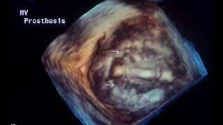 Sutures on cardiac valve prosthesis to drahmadmirdamadisihowm6yX0cFKAczR [upl. by Sillihp]