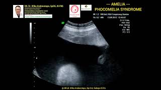 Amelia  Phocomelia syndrome [upl. by Kimberley136]