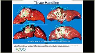 CAP education session Pediatric Hepatoblastoma Dr El Demellawy 2019 [upl. by Leirza]