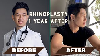 MY RHINOPLASTY amp CHIN AUGMENTATION JOURNEY  Dr Henry Claravall amp Dr Romeo Bato [upl. by Andel]