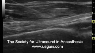 Monitoring the spread of local anaesthetics [upl. by Drabeck14]