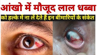 आंख लाल होने का कारण  subconjunctival hemorrhage in hindi  subconjunctival hemorrhage treatment [upl. by Narag]