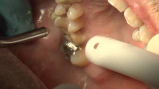 Premier CEREC Prep [upl. by Rammaj]