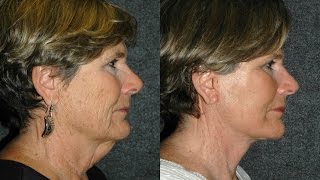 Face Lift Before and After NYC 60 year old woman  Dr Andrew Jacono Facelift minifacelift [upl. by Inahs]