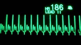 Atrial Tachycardia [upl. by Solram]