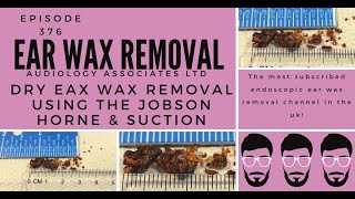 DRY EAR WAX REMOVAL USING JOBSON HORNE AND SUCTION EP 376 [upl. by Oer]