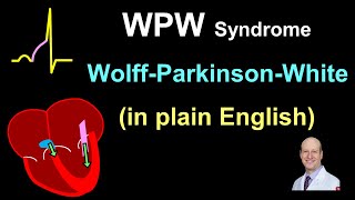 WPW Explanation and Treatment  in Plain English [upl. by Maxine]