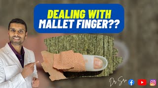 What is mallet finger and how to splint sportsinjuryclinic [upl. by Mur]