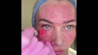 Microneedling Technique  Under Eye [upl. by Schnell890]