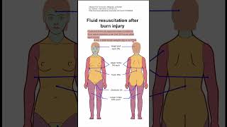 Fluid resuscitation after burn injury [upl. by Hashim158]