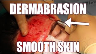 Dermabrasion for Smooth Skin Acne Scars Treatment and Smaller Pores [upl. by Akihsat]