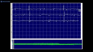 Kimura amp Kohara F21 positive sharp waves and fibrillation potentials each firing regularly [upl. by Jade]