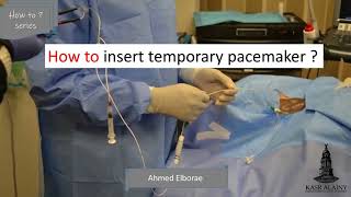 Temporary Pacemaker interventionalcardiology emergency [upl. by Elfreda375]