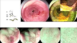 ESD for esophageal Squamous Carcinoma in a Patient with Achalasia [upl. by Haletky]