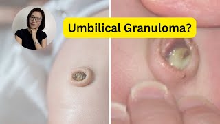 Umbilical Granuloma Treatment and Taking care of babys umbilical cord  Dr Kristine Alba Kiat [upl. by Katinka]