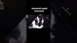 Interatrial septal aneurysm [upl. by Ettenig489]