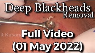 Deep Blackheads Removal with Cotton Bud amp Extractor Full Video By DrLalit Kasana [upl. by Nrubyar]