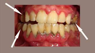 Periodontitis Treatment  Miracle Cure of Gum Disease and Periodontitis [upl. by Eustashe]