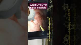 Adult Live Liver Fluke Fasciola found during ERCP [upl. by Stone581]