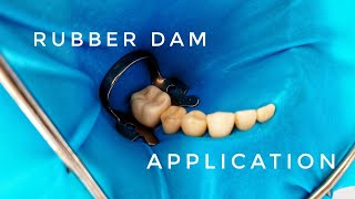 Rubber Dam Application [upl. by Yevoc]