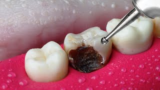 ASMR Restoration Incredible Tooth Cavity And The Master Dentist [upl. by Aticilef]